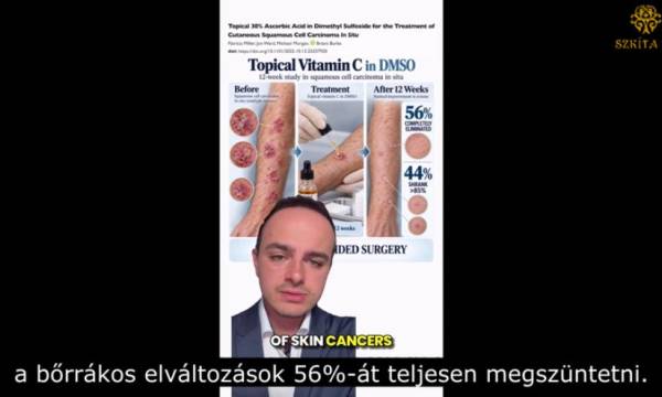 Tanulmány a C-vitamin hatásáról, melyet közvetlenül a bőrrákra fecskendeztek